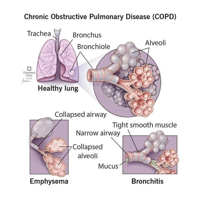 Medical visualization of respiratory diseases caused by industrial exposure
