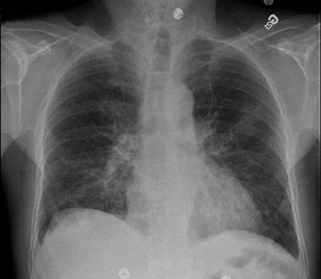 Healthy vs damaged lungs showing the effects of toxic particulate exposure
